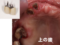 新浦安（浦安市）の歯医者のインプラント症例