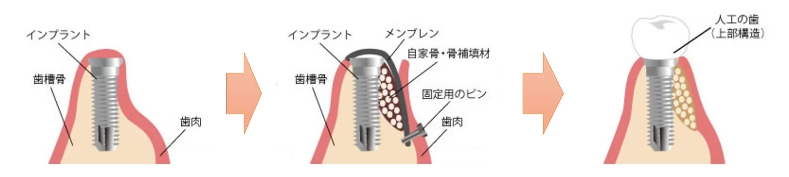 新浦安（浦安市）の歯医者でインプラント治療